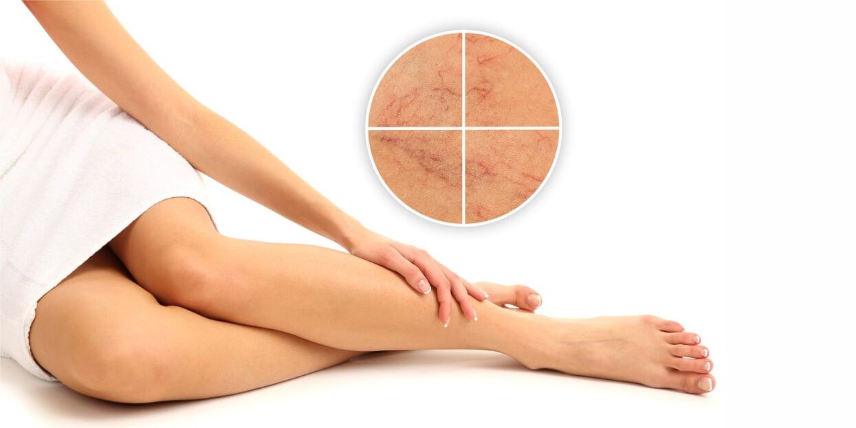 What are varicose veins in the legs